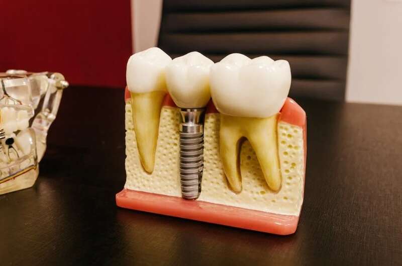 Cost Of Dental Implants